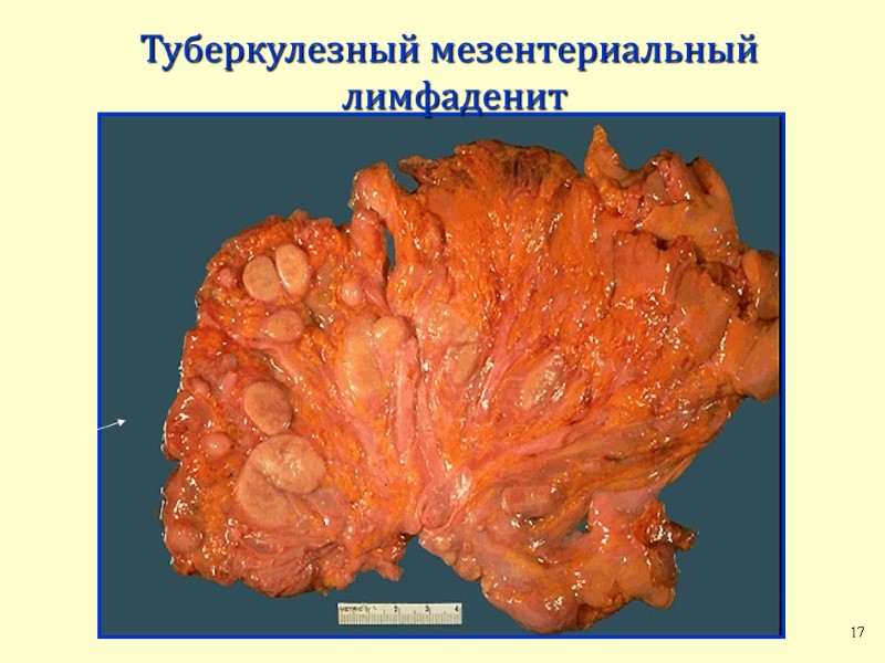 Туберкулезный мезентериальный  лимфаденит 17